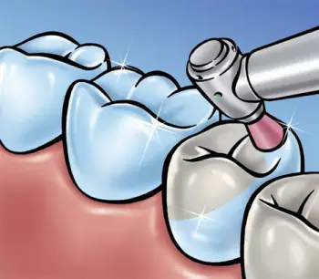 市口腔医院专家提醒：洗牙后做抛光可以使牙齿更光洁