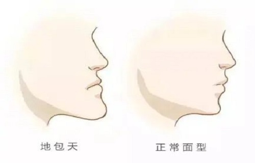 科普 | 儿童反颌治疗的关键年龄阶段