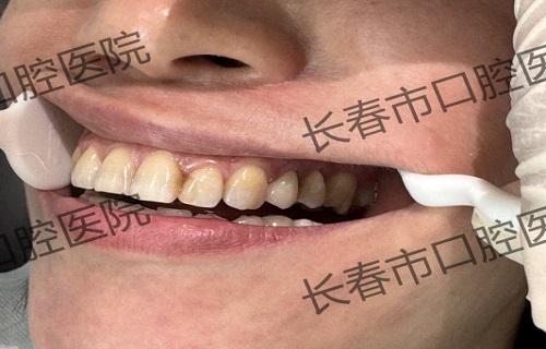 以数字化技术重塑患者体验，让精准诊疗触手可及——长春市口腔医院数字化诊疗中心开展椅旁修复实操培训