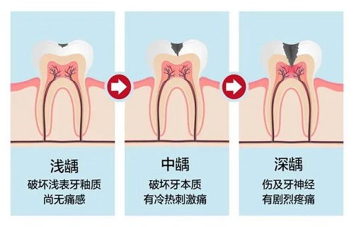 蛀牙的形成