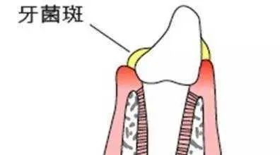 蛀牙1.jpg