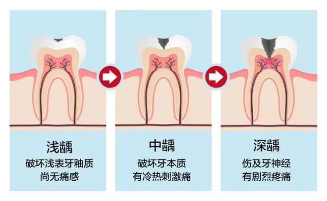 蛀牙3.jpg