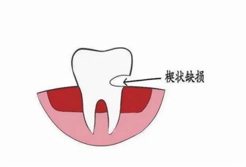 科普 | 牙齿的隐形杀手——楔状缺损